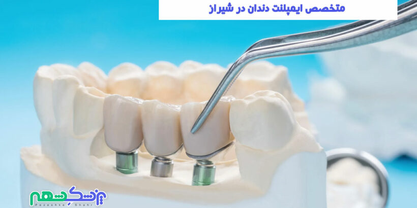 متخصص ایمپلنت دندان در شیراز