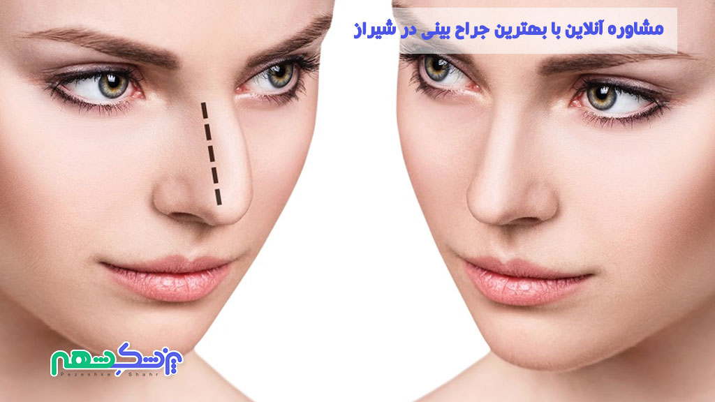 مشاوره آنلاین با بهترین جراح بینی در شیراز