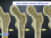 بهترین پزشکان درمان پوکی استخوان در شیراز