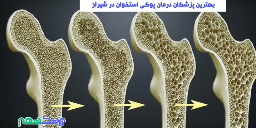 بهترین پزشکان درمان پوکی استخوان در شیراز
