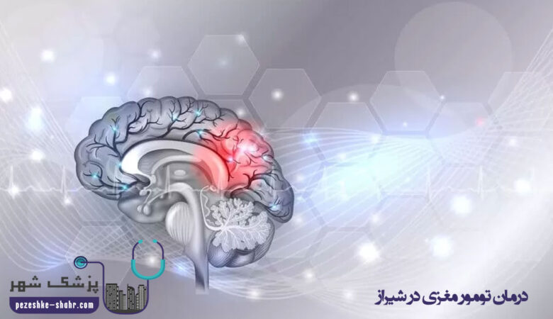 درمان تومور مغزی در شیراز