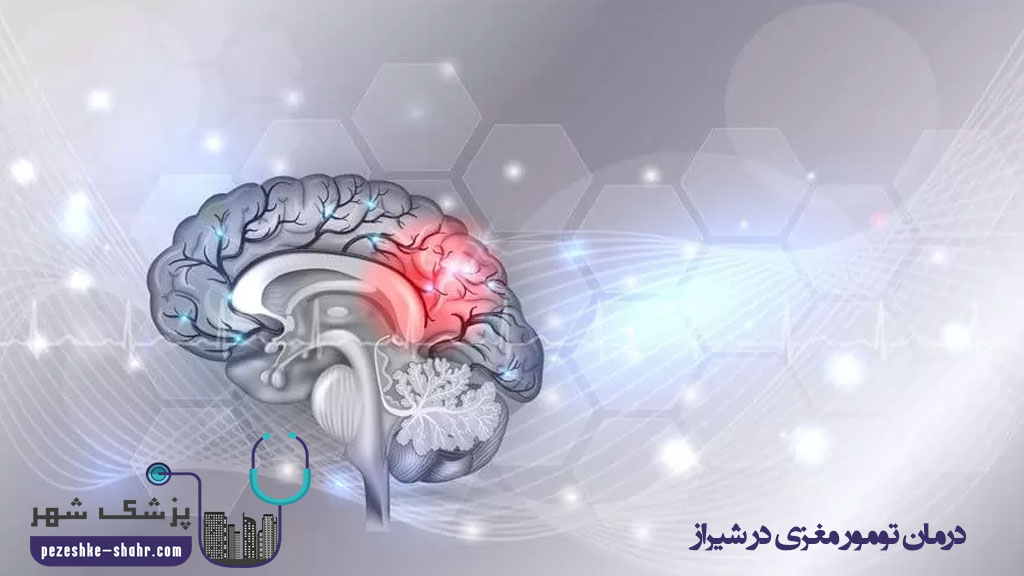 درمان تومور مغزی در شیراز