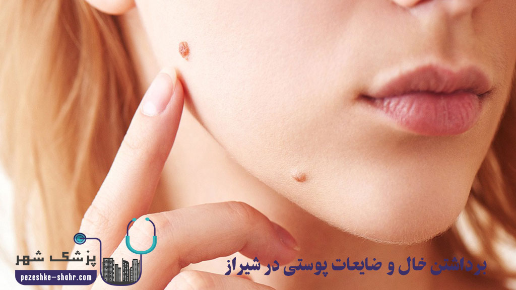 برداشتن خال و ضایعات پوستی در شیراز