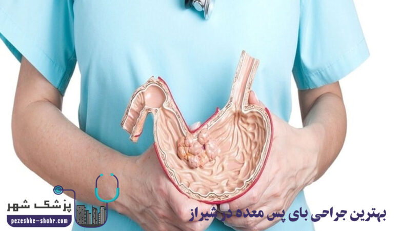 جراحی بای پس معده در شیراز