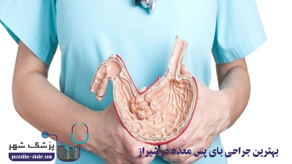 جراحی بای پس معده در شیراز