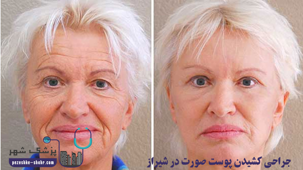 جراحی کشیدن پوست صورت در شیراز