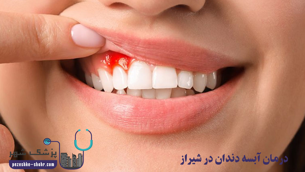 درمان آبسه دندان در شیراز