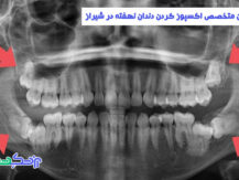 متخصص اکسپوز کردن دندان نهفته در شیراز