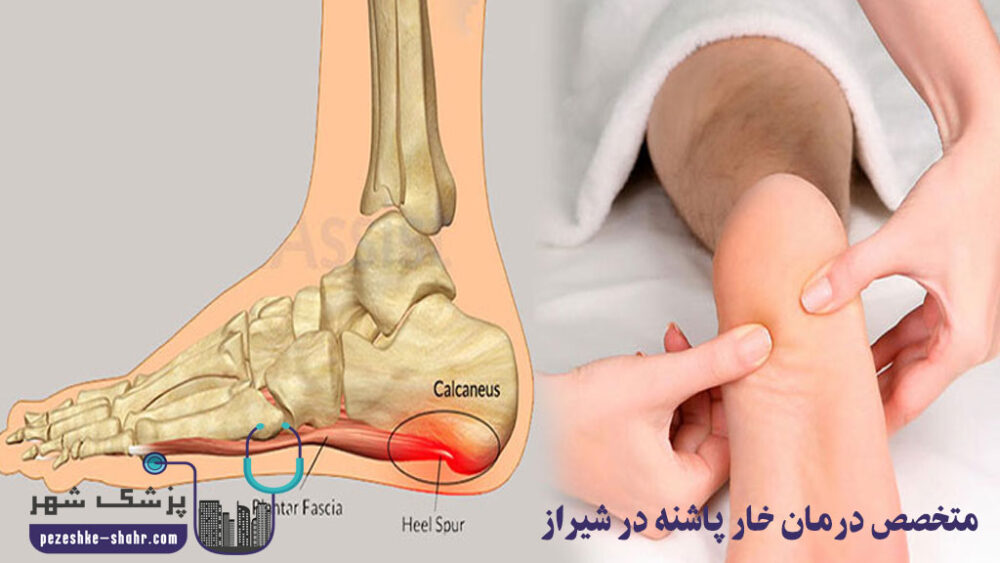 متخصص درمان خار پاشنه در شیراز