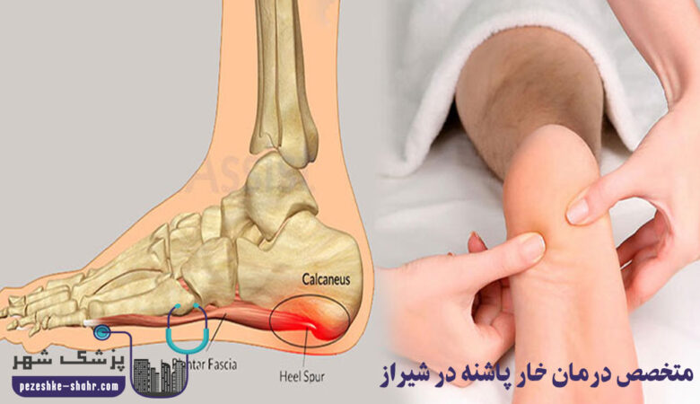 متخصص درمان خار پاشنه در شیراز