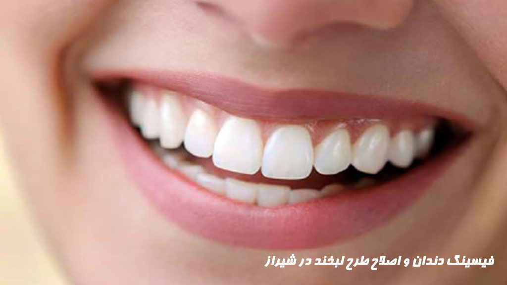 فیسینگ دندان و اصلاح طرح لبخند در شیراز
