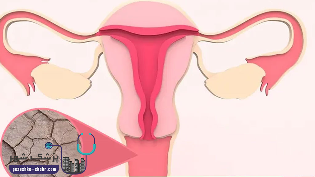 متخصص درمان خشکی واژن در شیراز