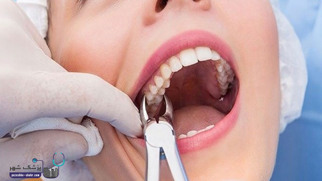 جراحی دندان عقل در شیراز