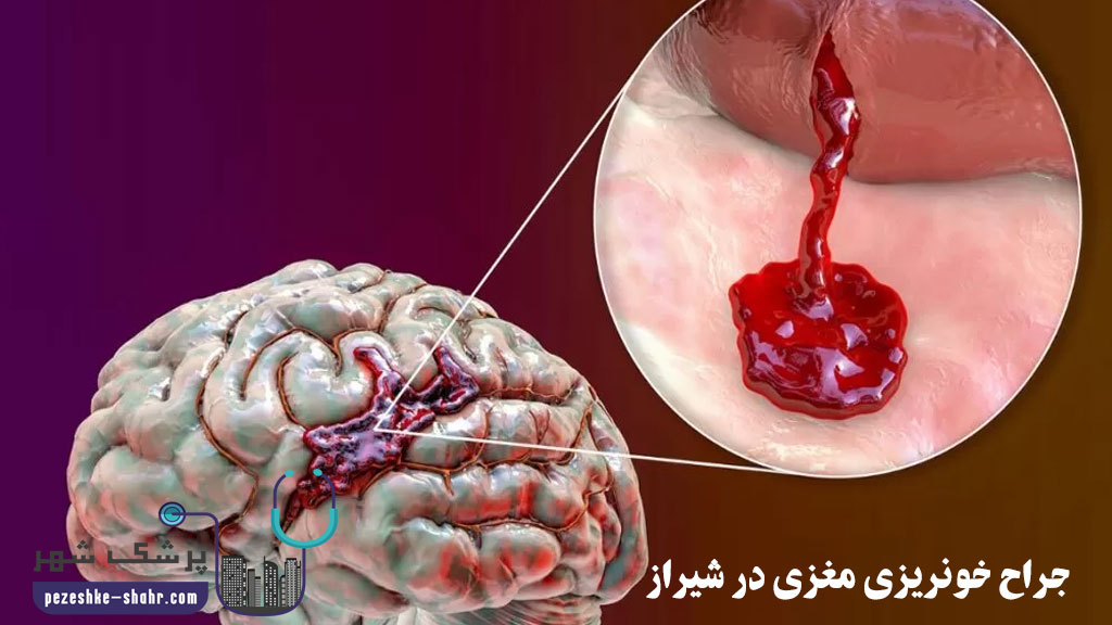 جراح خونریزی مغزی در شیراز