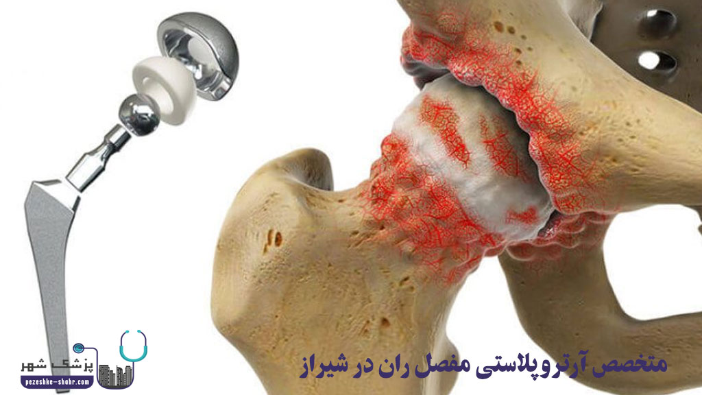 متخصص آرتروپلاستی مفصل ران در شیراز