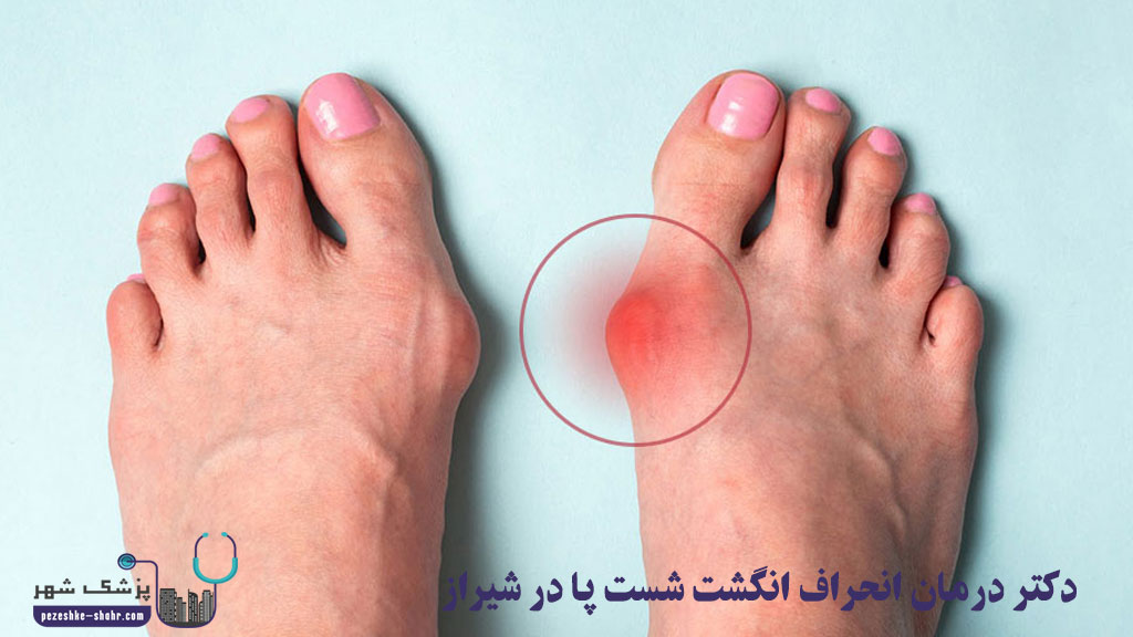 دکتر درمان انحراف انگشت شست پا در شیراز