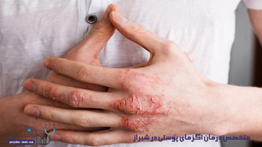 متخصص درمان اگزمای پوستی در شیراز