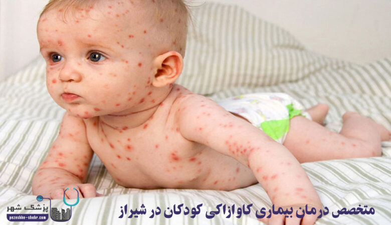 متخصص درمان بیماری کاوازاکی کودکان در شیراز