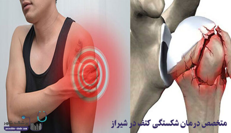 متخصص درمان شکستگی کتف در شیراز
