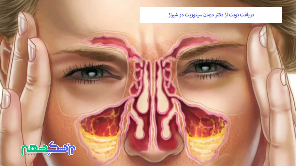 دریافت نوبت از دکتر درمان سینوزیت در شیراز