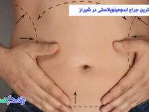 بهترین جراح ابدومینوپلاستی در شیراز