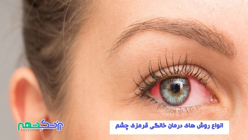 انواع روش های درمان خانگی قرمزی چشم