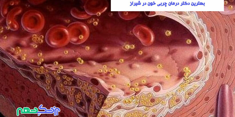 درمان چربی خون در شیراز
