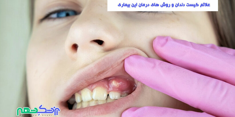 علائم کیست دندان و روش های درمان این بیماری