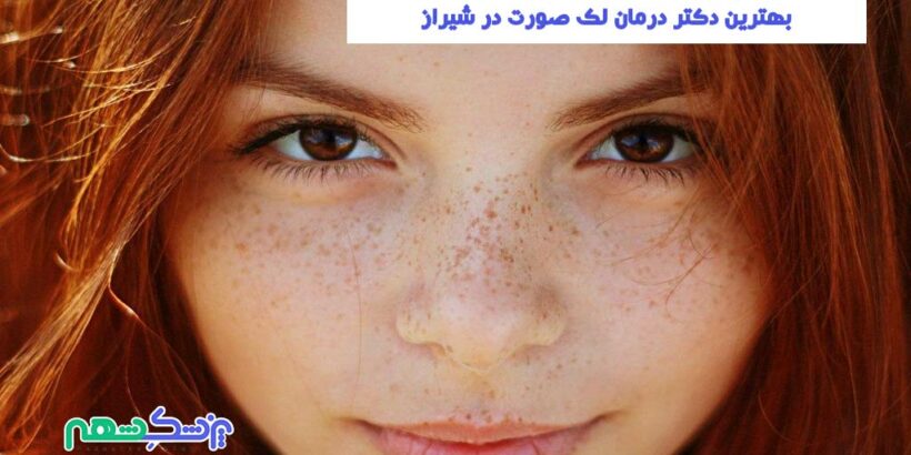 درمان لک صورت در شیراز