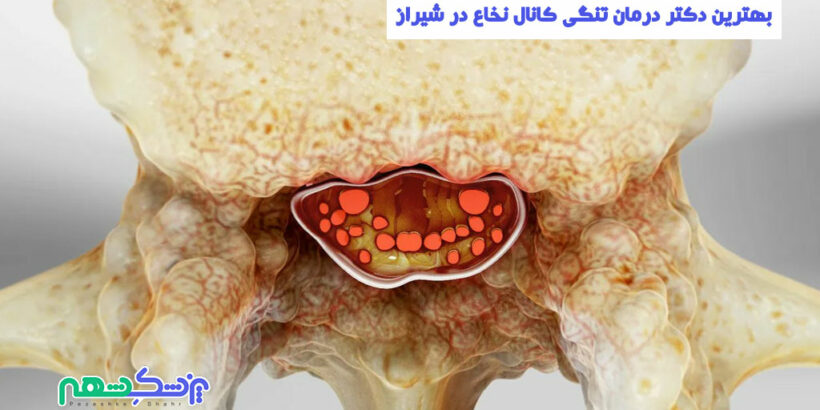 درمان تنگی کانال نخاع در شیراز