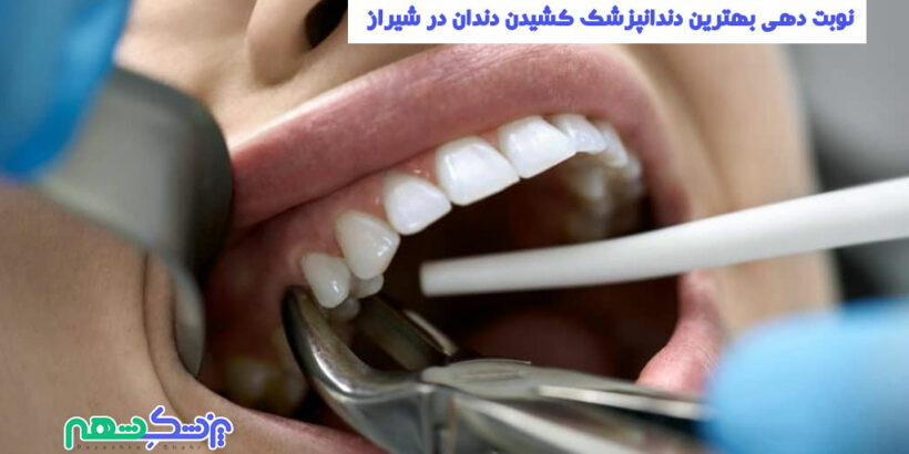 کشیدن دندان در شیراز