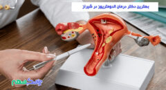 درمان اندومتریوز در شیراز