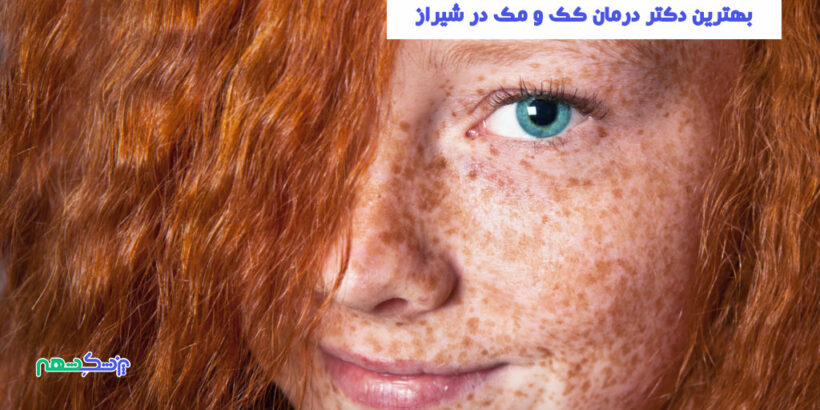 درمان کک و مک در شیراز