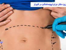 جراح لیپوساکشن در شیراز