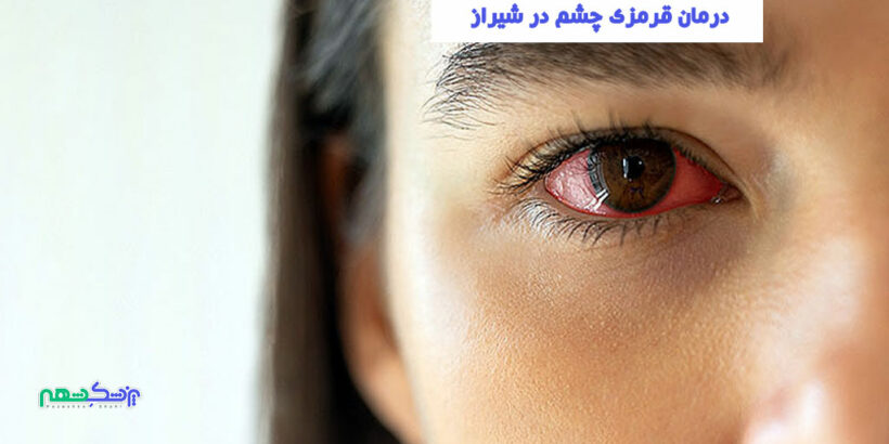 درمان قرمزی چشم در شیراز