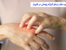 درمان آلرژی پوستی در شیراز