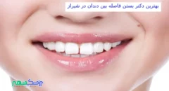 بستن فاصله بین دندان در شیراز