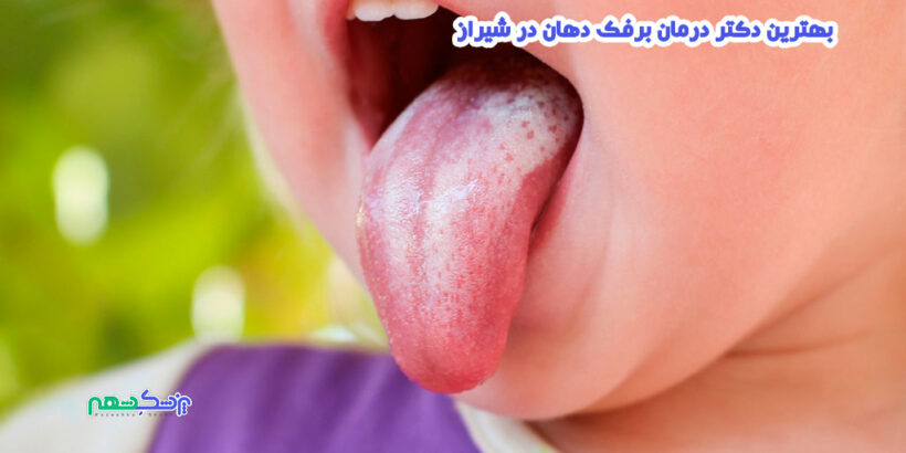 بهترین دکتر درمان برفک دهان در شیراز