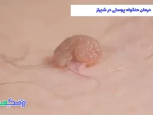 درمان منگوله پوستی در شیراز