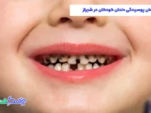 درمان پوسیدگی دندان کودکان در شیراز