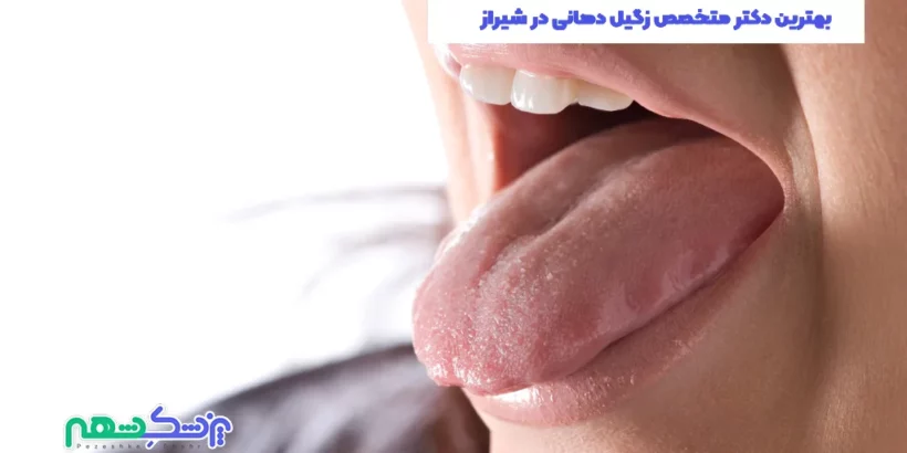 بهترین دکتر متخصص زگیل دهانی در شیراز