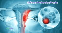درمان سرطان دهانه رحم در شیراز