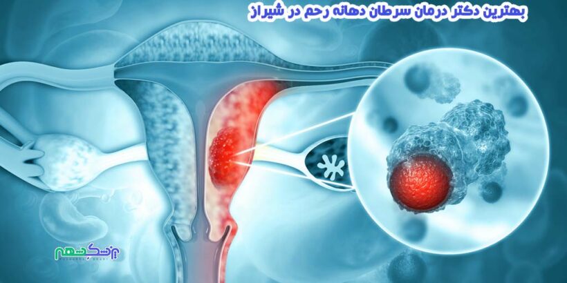 درمان سرطان دهانه رحم در شیراز