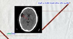 درمان کیست مغزی در شیراز