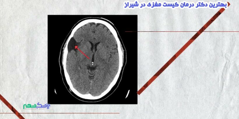 درمان کیست مغزی در شیراز