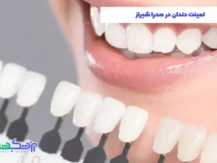 لمینت دندان در صدرا شیراز