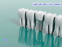 متخصص ایمپلنت دندان در قصردشت شیراز