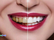 کامپوزیت دندان برند کازمادنت COSMEDENT چیست و چه مزایایی دارد؟