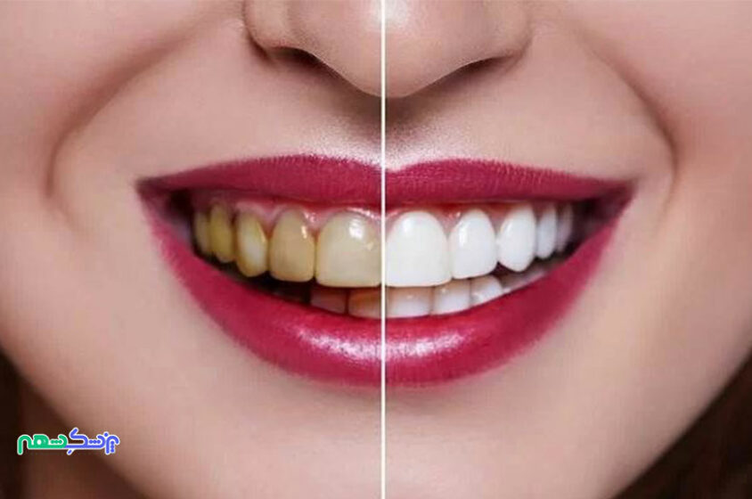 کامپوزیت دندان برند کازمادنت COSMEDENT چیست و چه مزایایی دارد؟