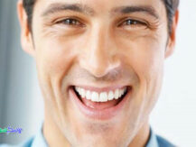 کامپوزیت دندان برند شوفو SHOFU چیست و چه مزایایی دارد؟
